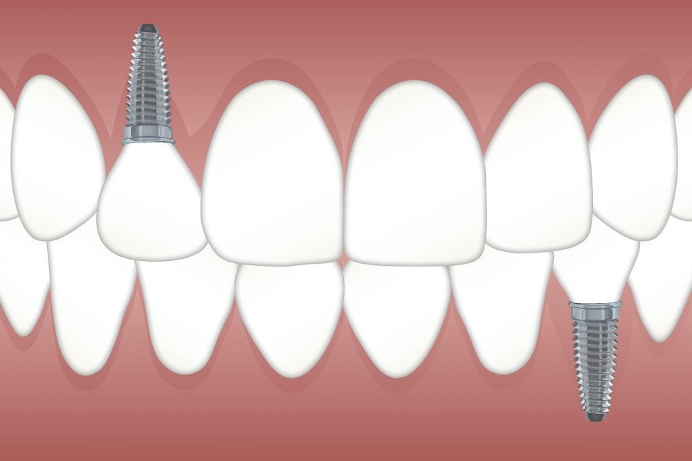 Tandläkare i Kista erbjuder protes, implantat samt kronor och broar för att ersätta förlorade tänder